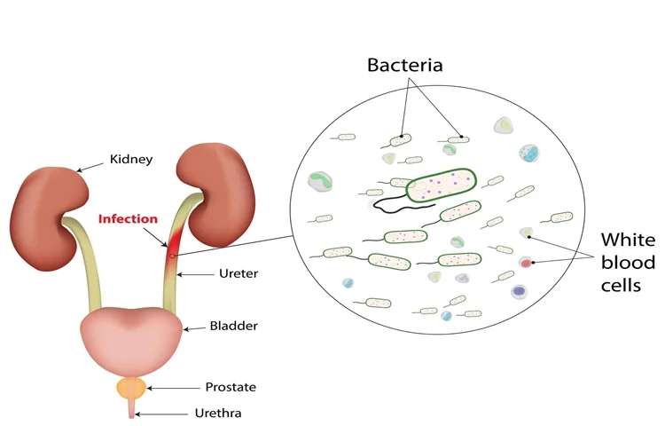 Urinary Tract Infection